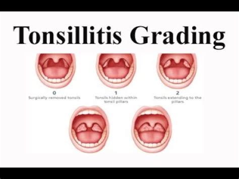 tonsillitis grade